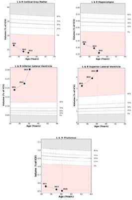 Gray Matter Matters: A Longitudinal Magnetic Resonance Voxel-Based Morphometry Study of Primary Progressive Multiple Sclerosis